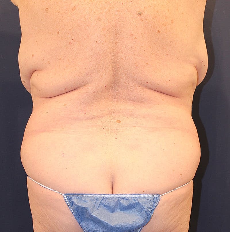 Tummy Tuck Before & After