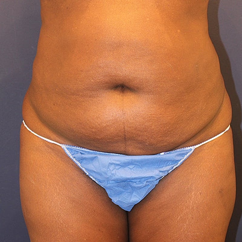 Tummy Tuck Before & After