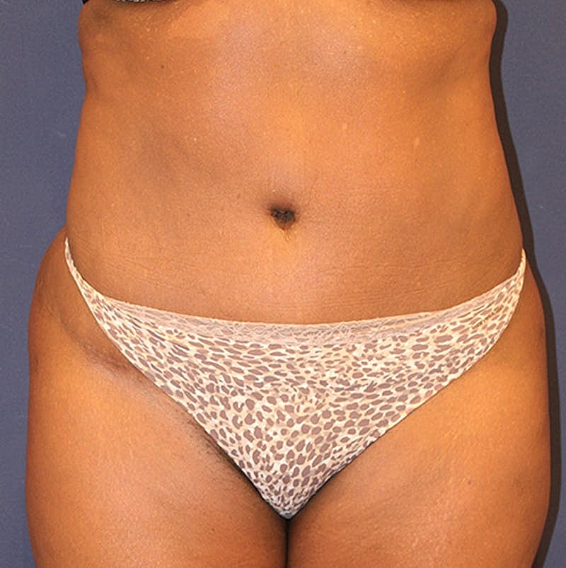 Tummy Tuck Before & After