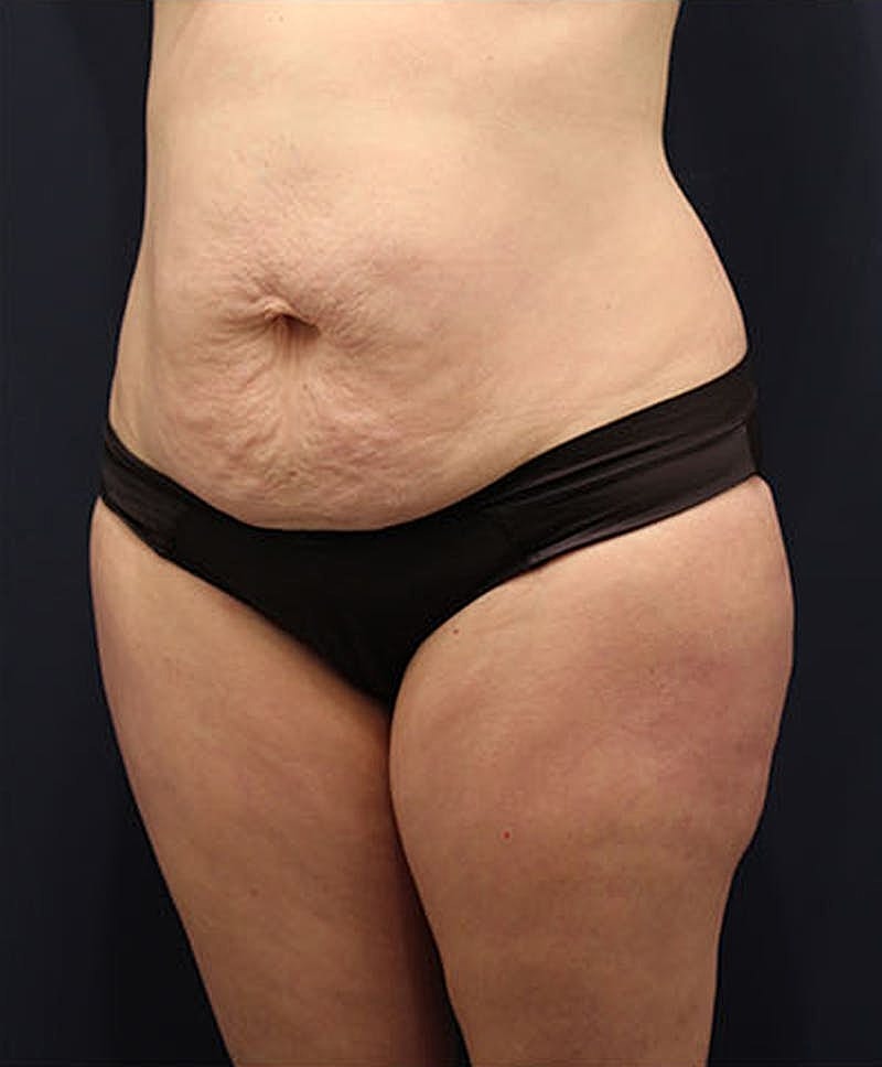 Tummy Tuck Before & After