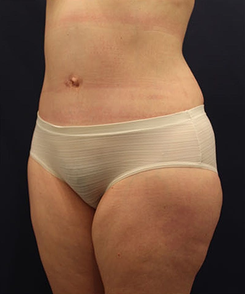 Tummy Tuck Before & After