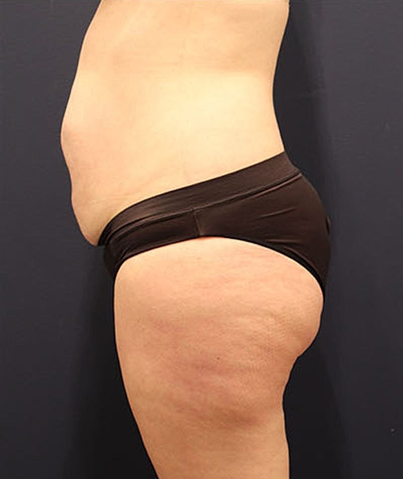 Tummy Tuck Before & After