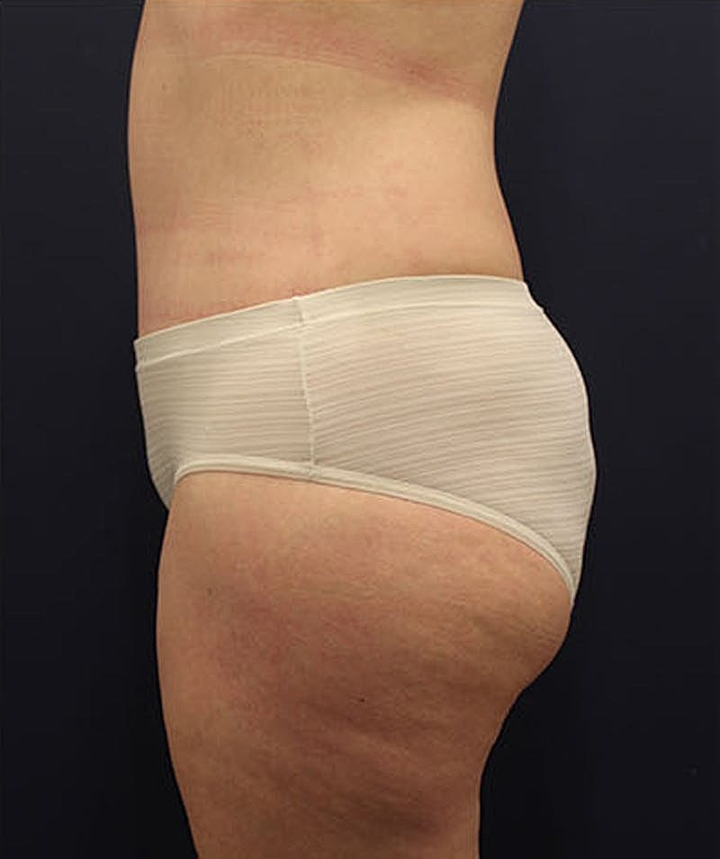 Tummy Tuck Before & After