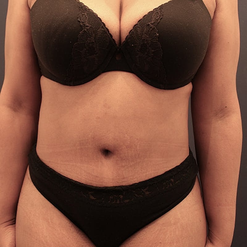 Tummy Tuck Before & After