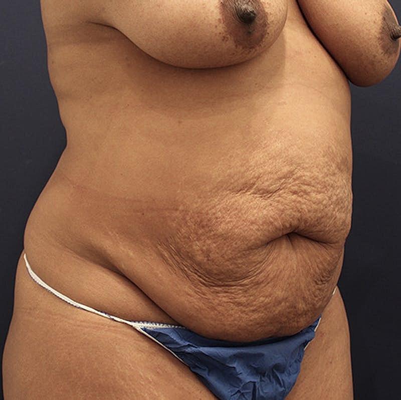 Tummy Tuck Before & After