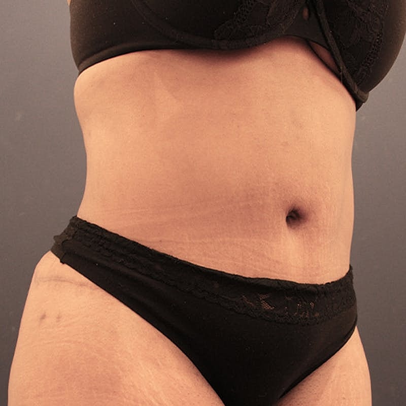 Tummy Tuck Before & After