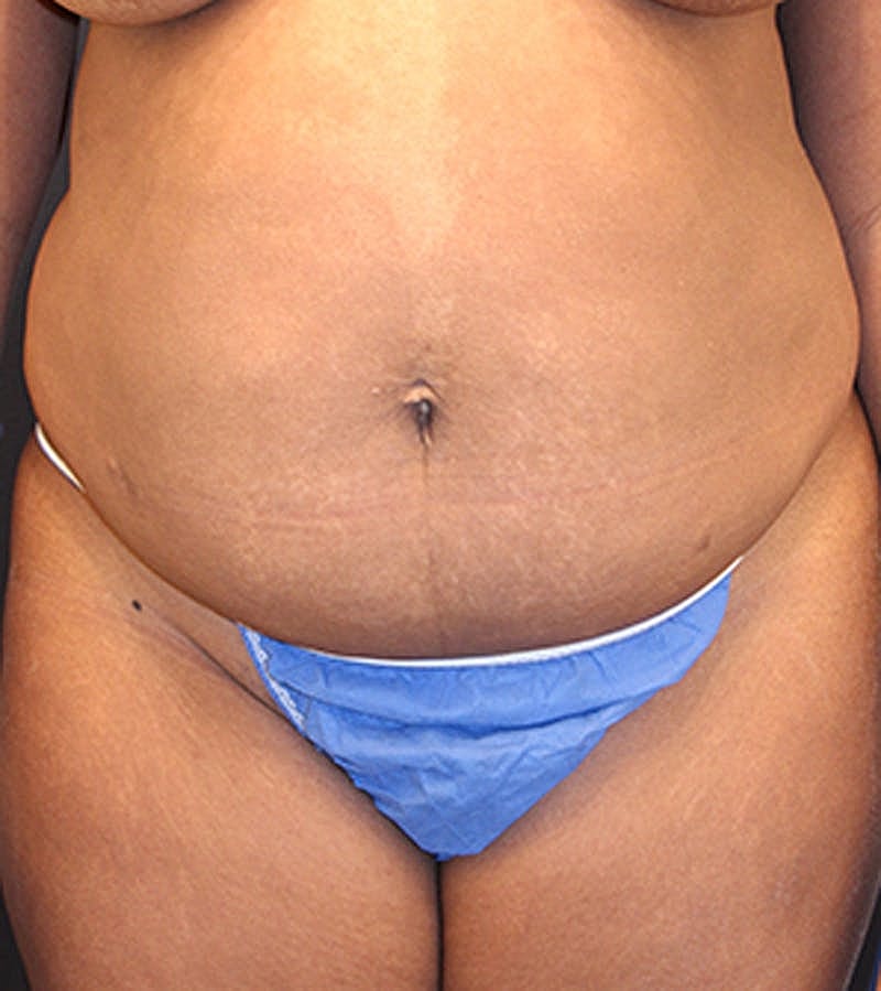Tummy Tuck Before & After
