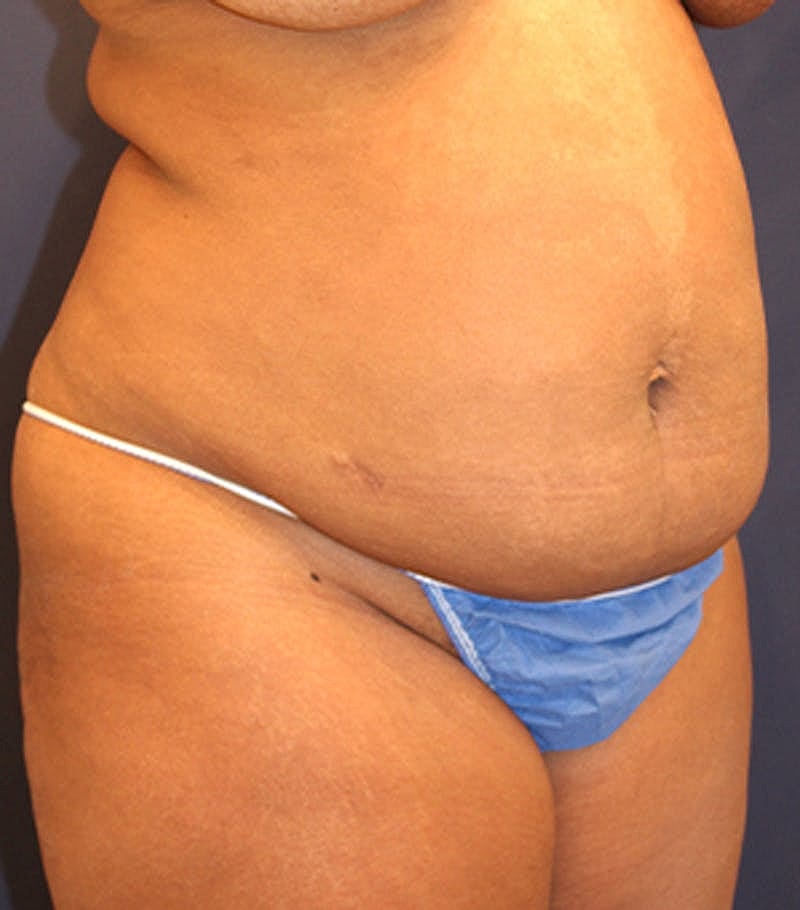 Tummy Tuck Before & After