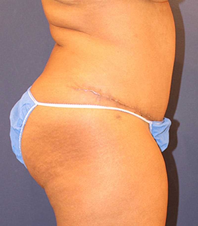 Tummy Tuck Before & After