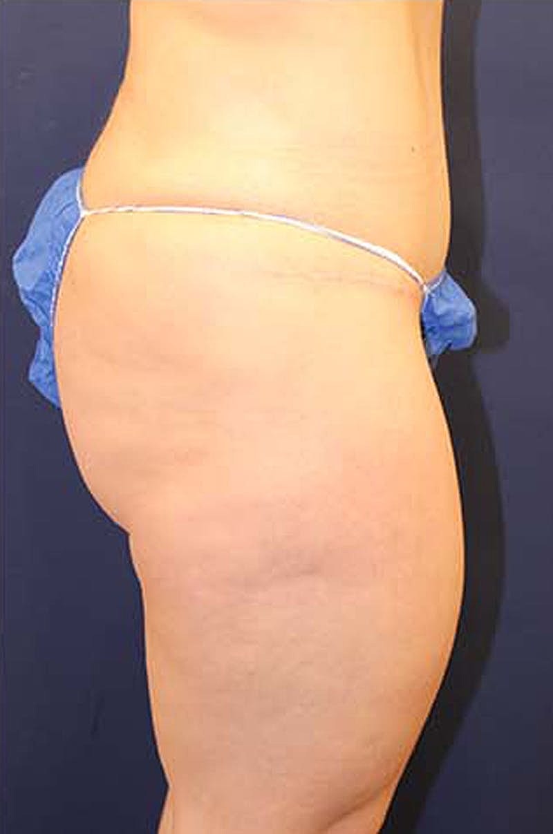 Tummy Tuck Before & After