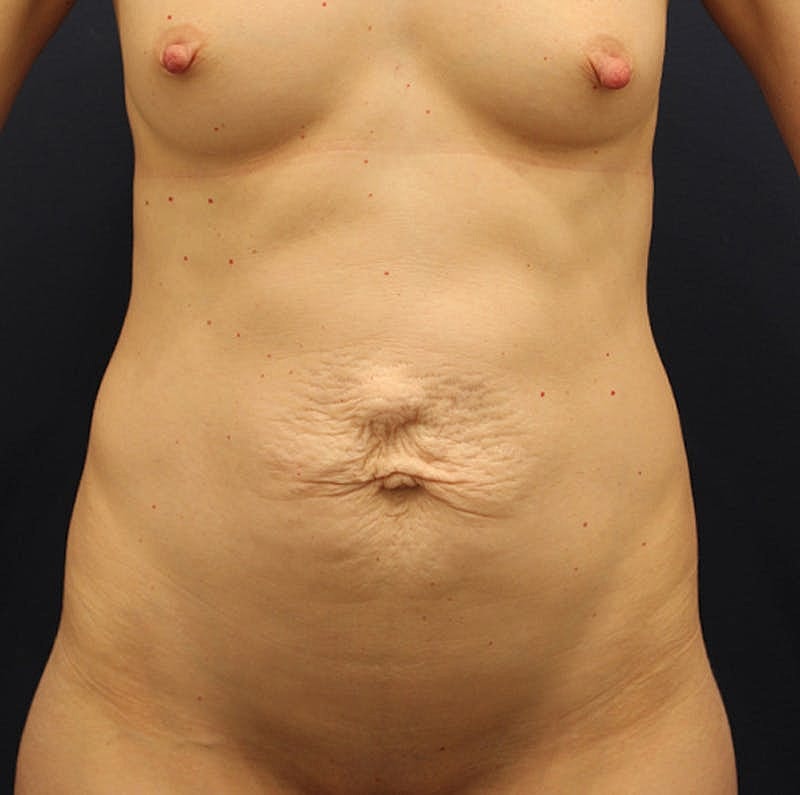 Tummy Tuck Before & After