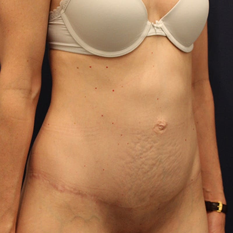 Tummy Tuck Before & After