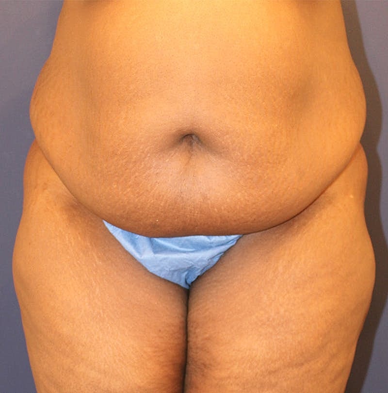 Tummy Tuck Before & After