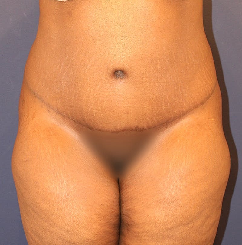Tummy Tuck Before & After