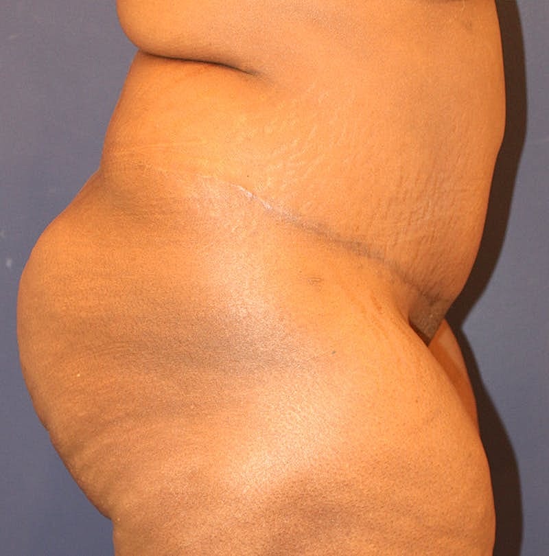 Tummy Tuck Before & After