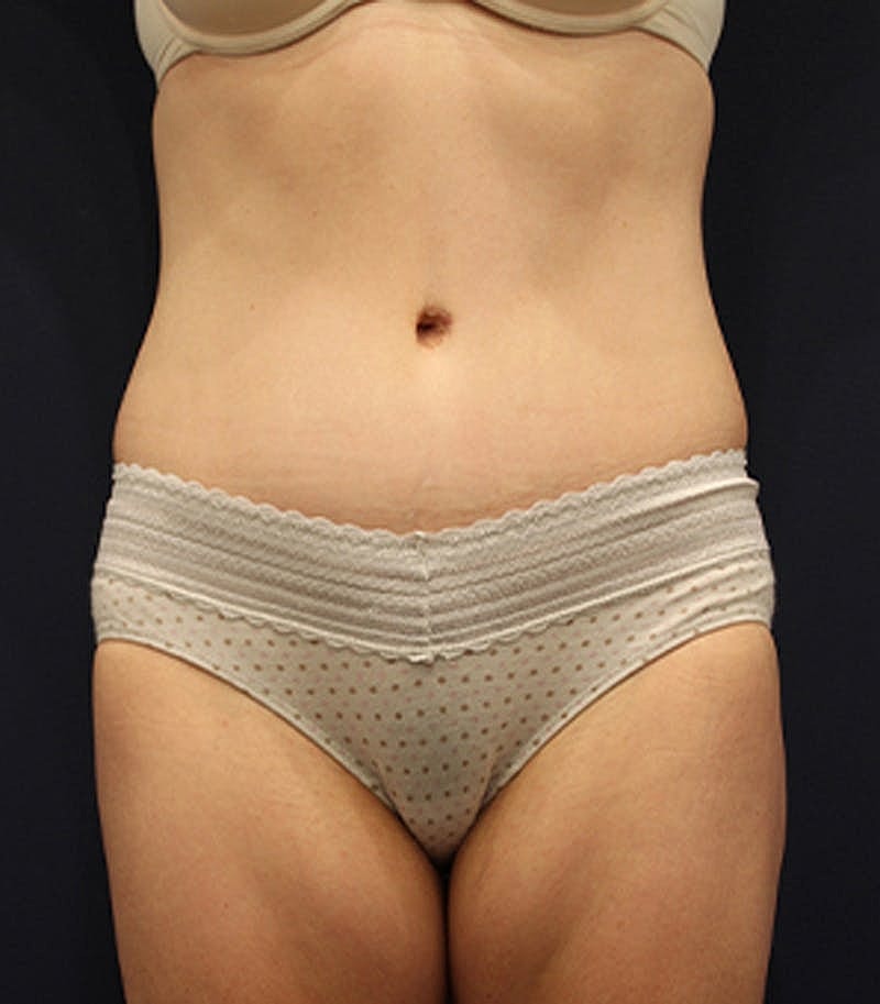 Tummy Tuck Before & After