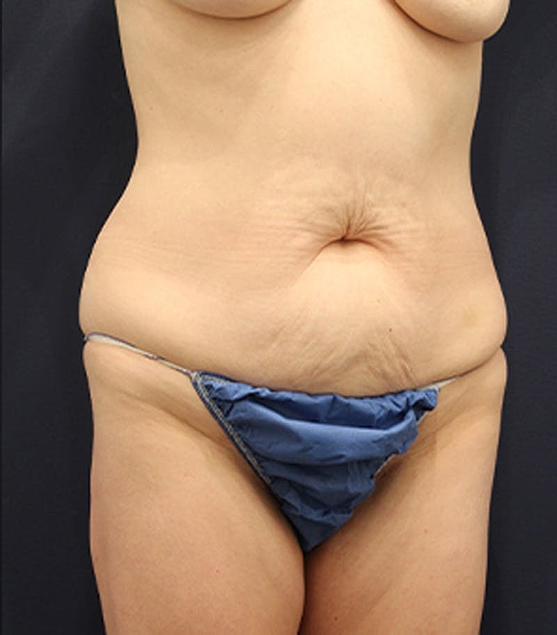 Tummy Tuck Before & After