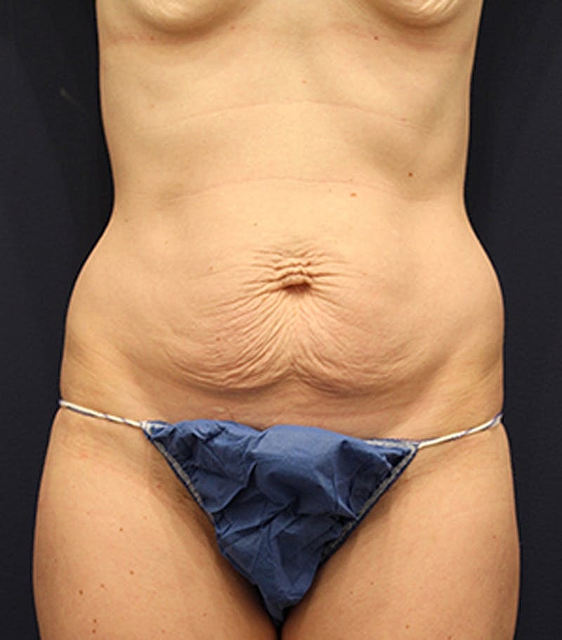 Tummy Tuck Before & After
