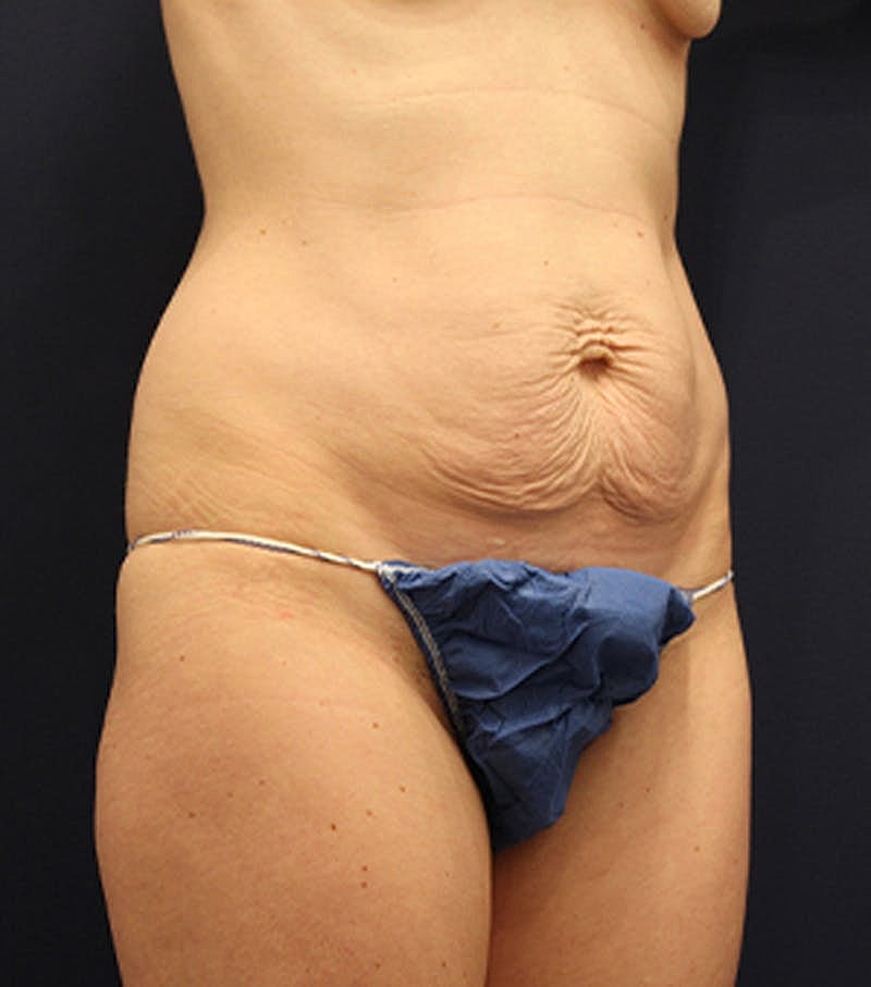 Tummy Tuck Before & After