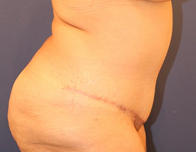 Tummy Tuck Before & After