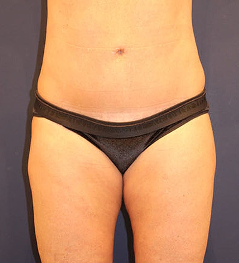 Tummy Tuck Before & After