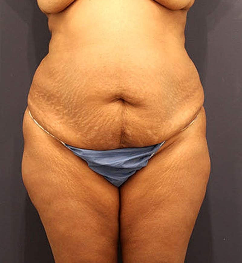 Tummy Tuck Before & After