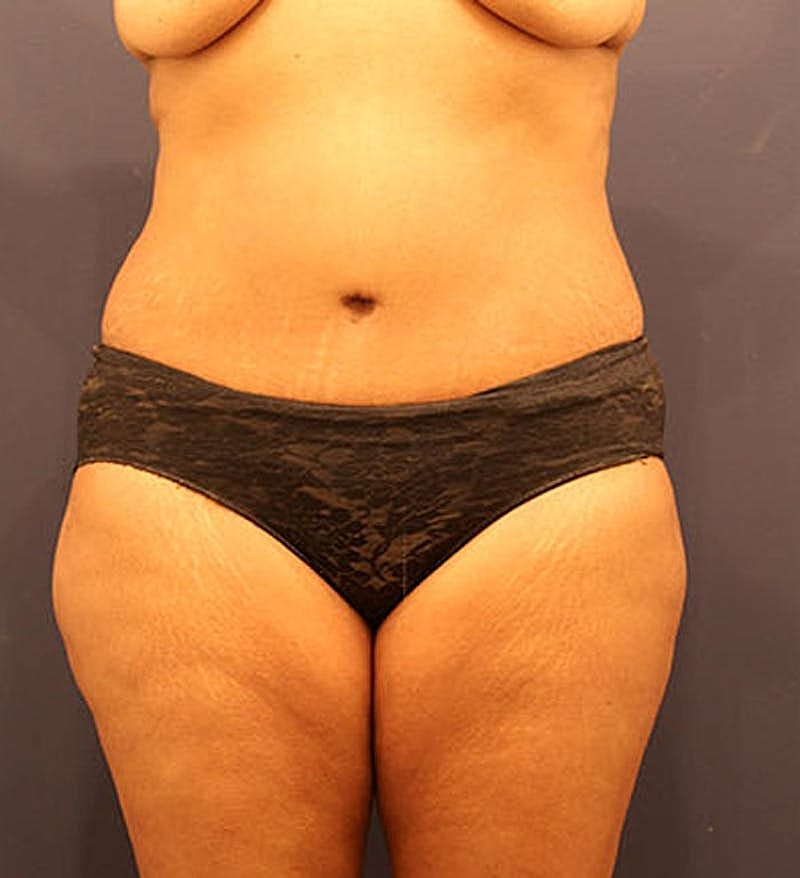 Tummy Tuck Before & After