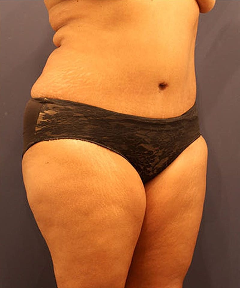 Tummy Tuck Before & After