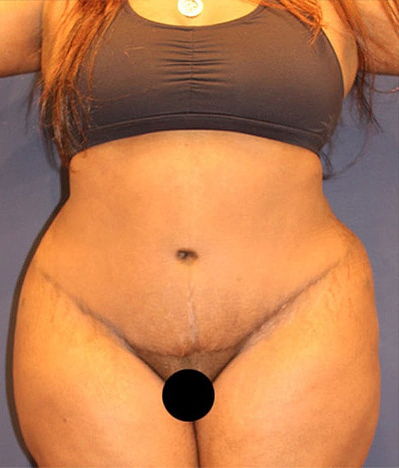 Tummy Tuck Before & After