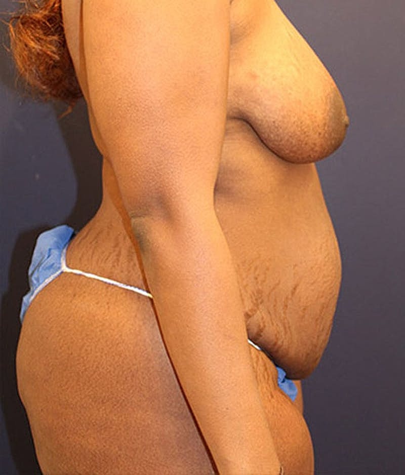 Tummy Tuck Before & After