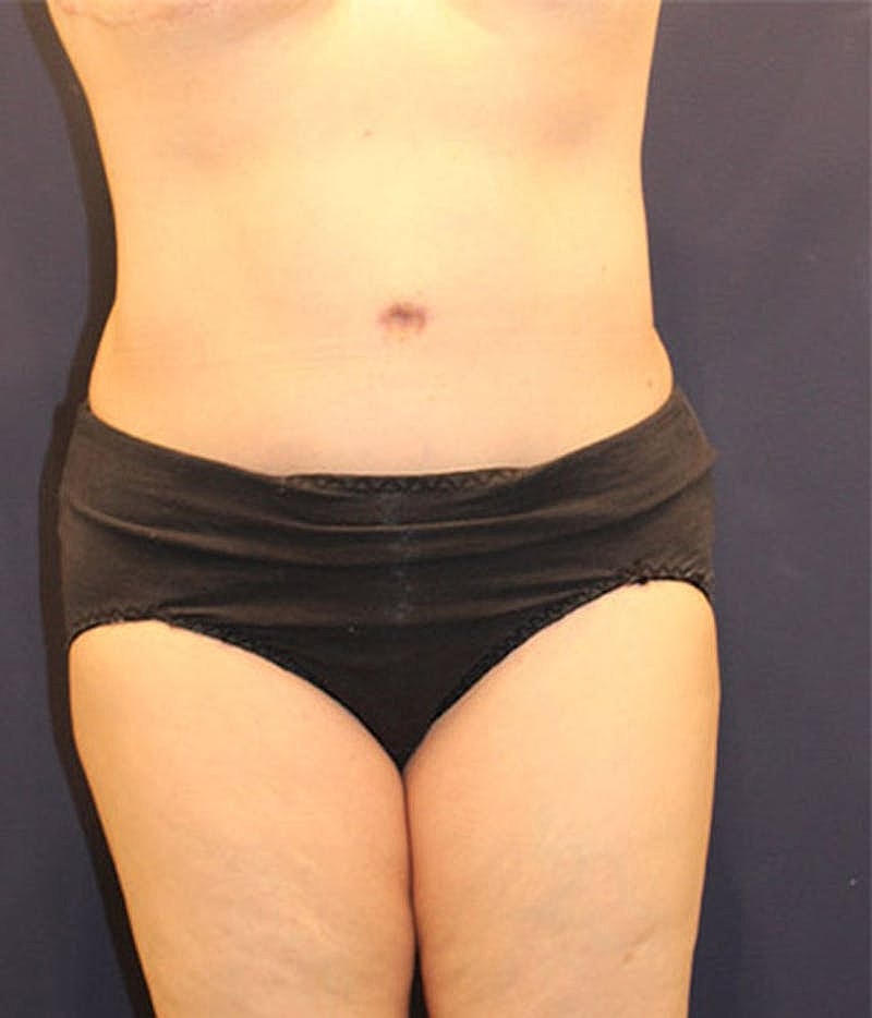 Tummy Tuck Before & After