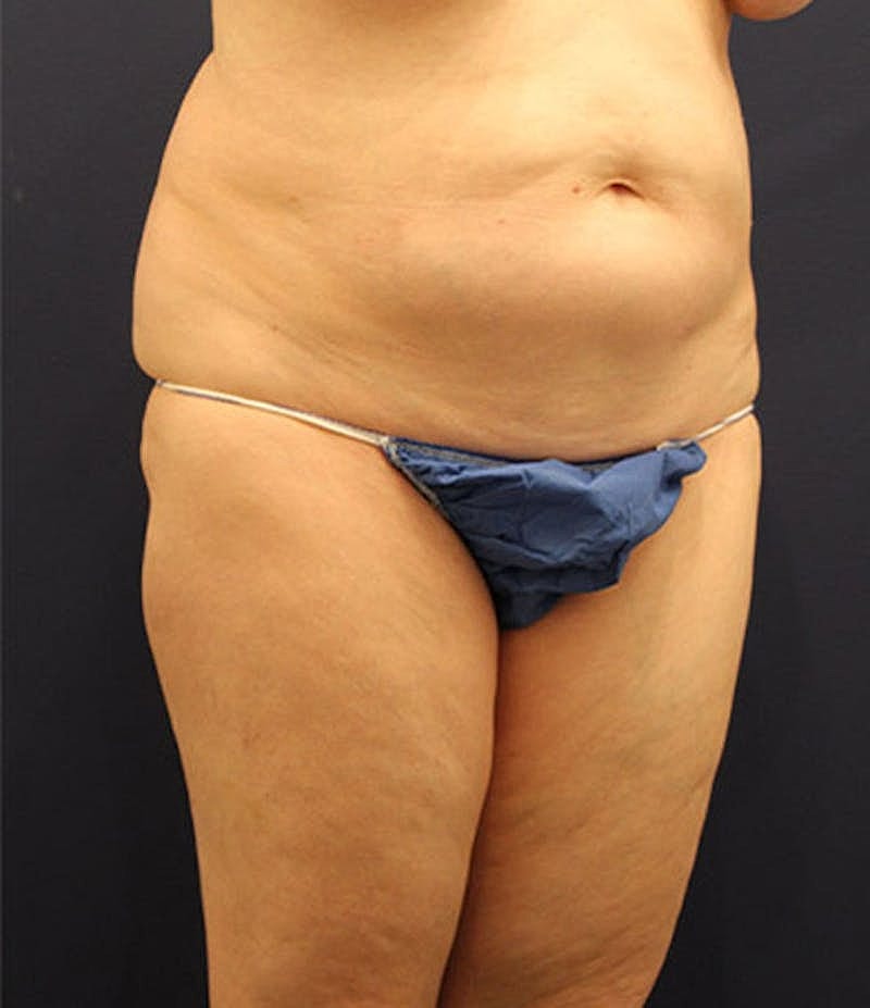 Tummy Tuck Before & After