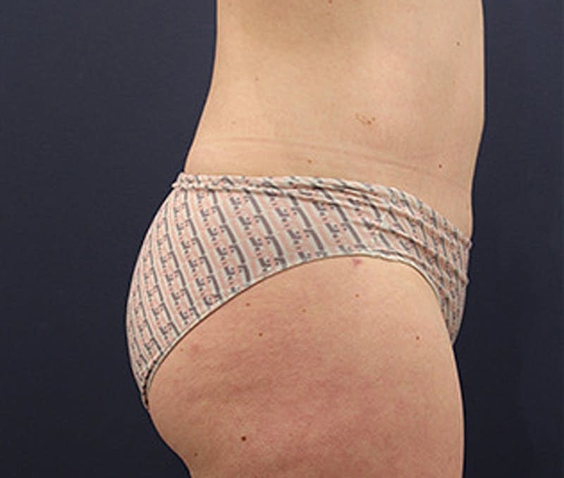 Tummy Tuck Before & After