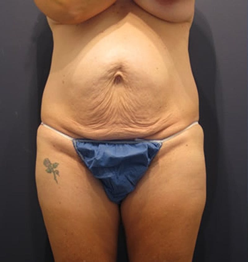 Tummy Tuck Before & After