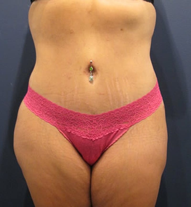 Tummy Tuck Before & After