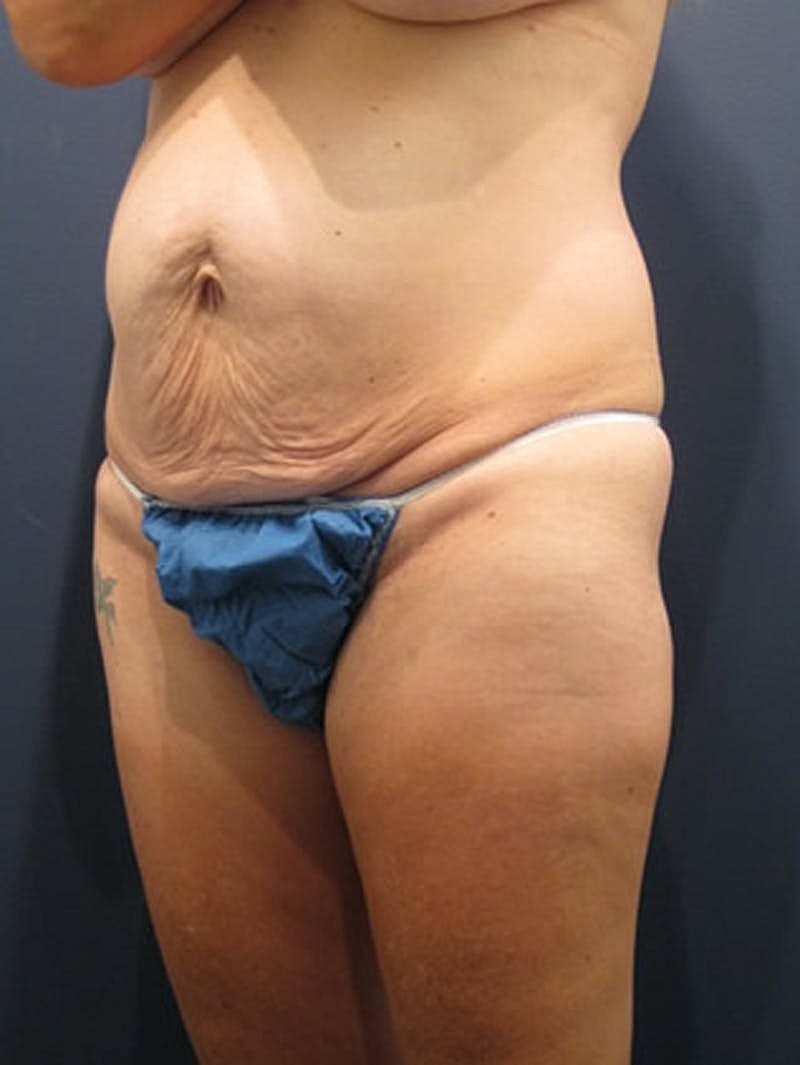 Tummy Tuck Before & After