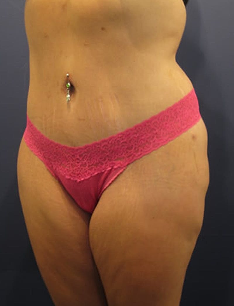 Tummy Tuck Before & After