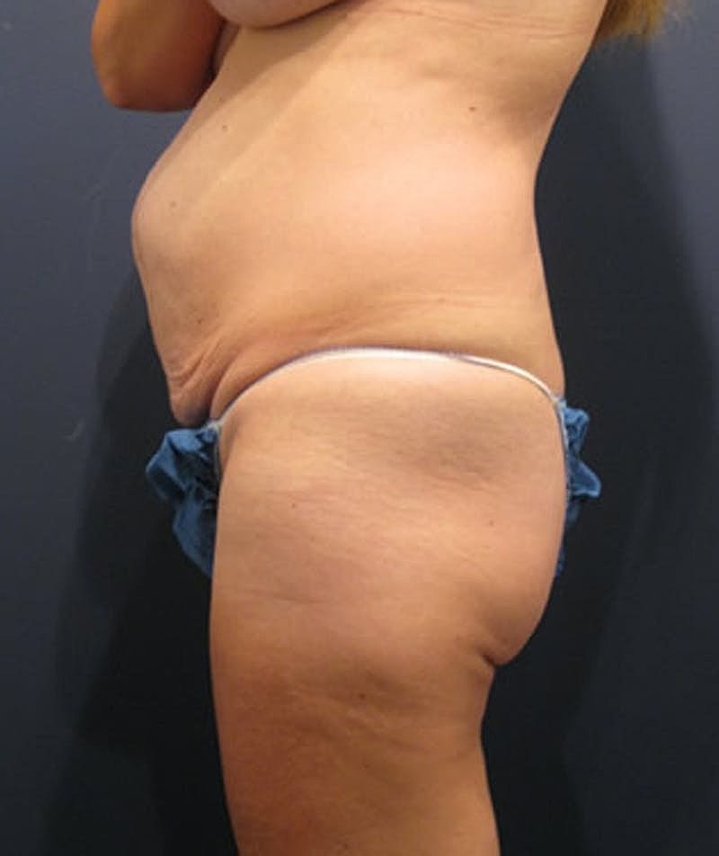 Tummy Tuck Before & After