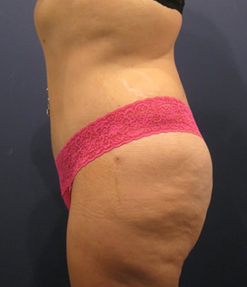 Tummy Tuck Before & After