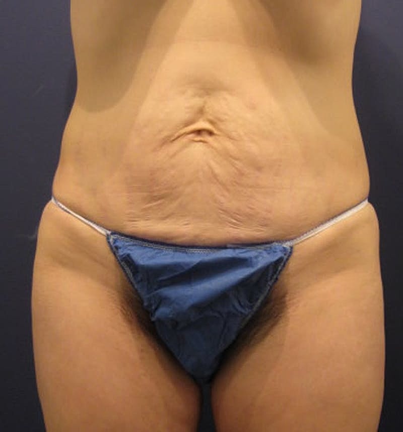 Tummy Tuck Before & After