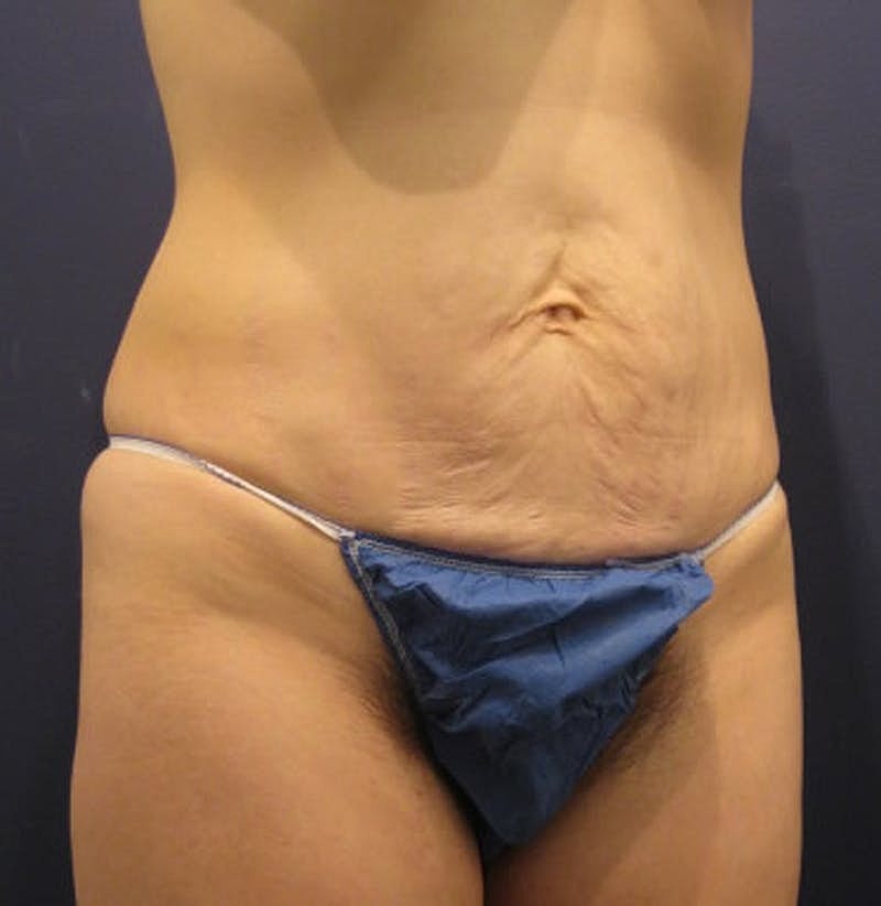 Tummy Tuck Before & After