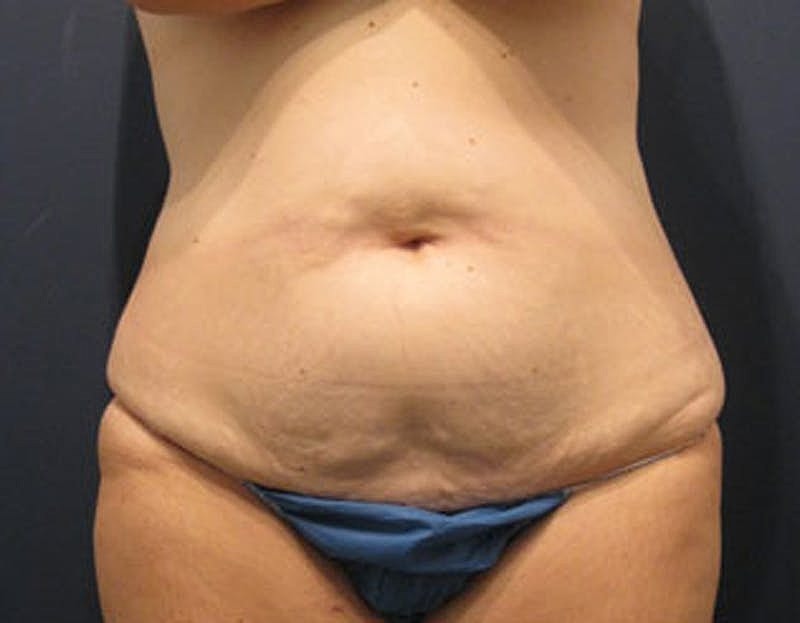 Tummy Tuck Before & After