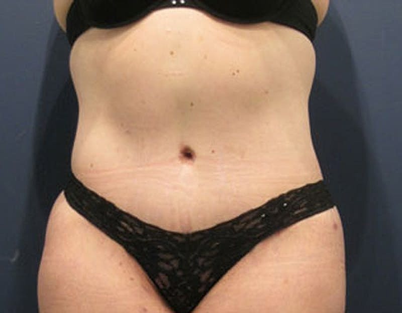 Tummy Tuck Before & After