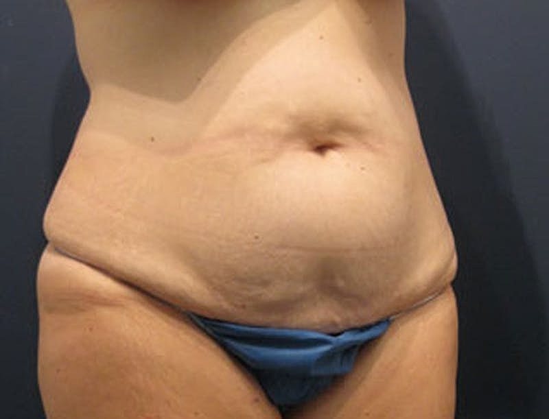 Tummy Tuck Before & After