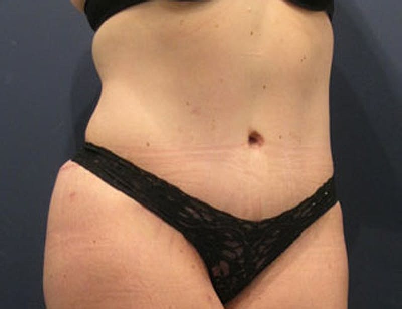 Tummy Tuck Before & After