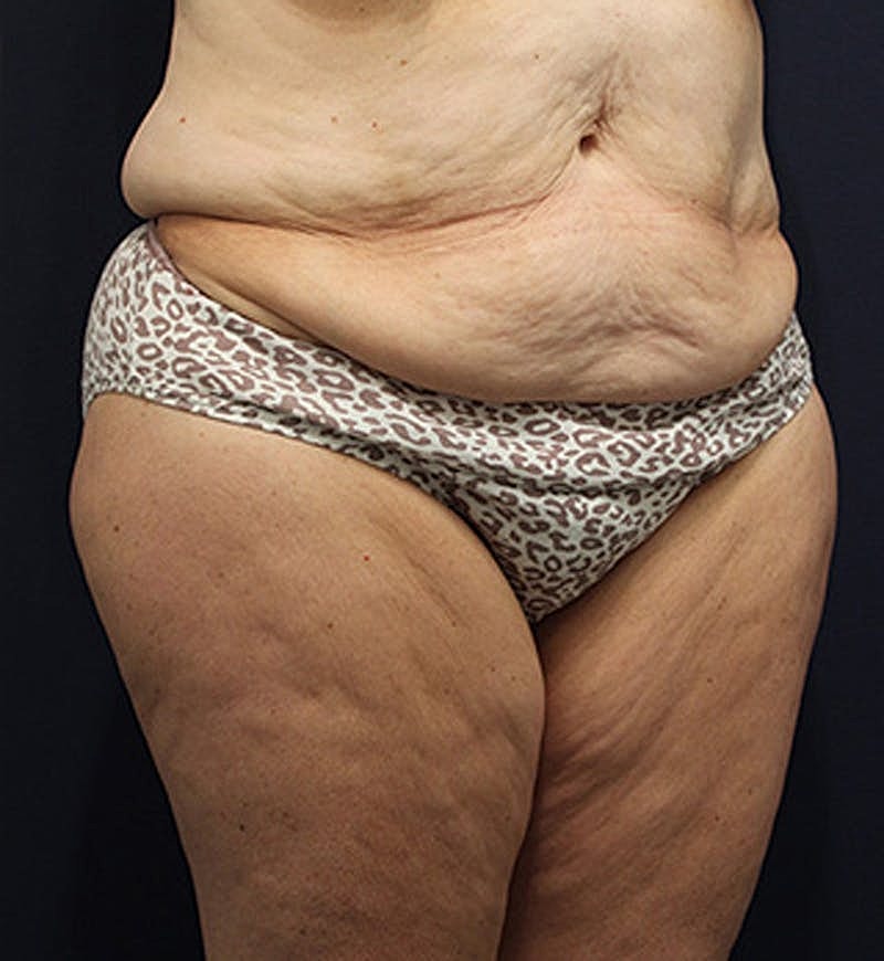 Tummy Tuck Before & After