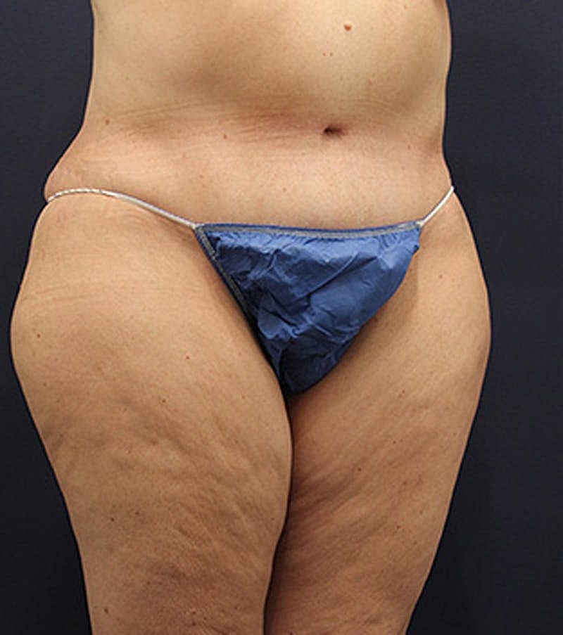 Tummy Tuck Before & After