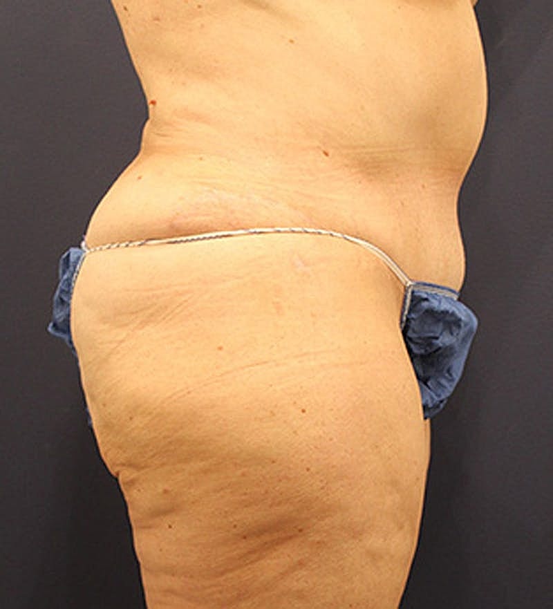 Tummy Tuck Before & After