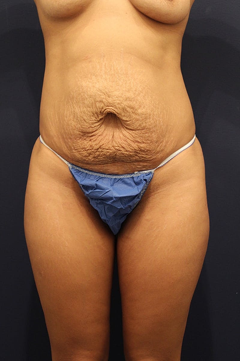 Tummy Tuck Before & After