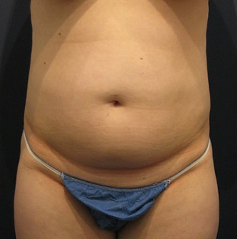 Tummy Tuck Before & After